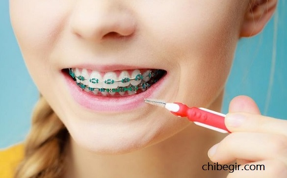 خرید و قیمت بهترین مدل مسواک ارتودنسی